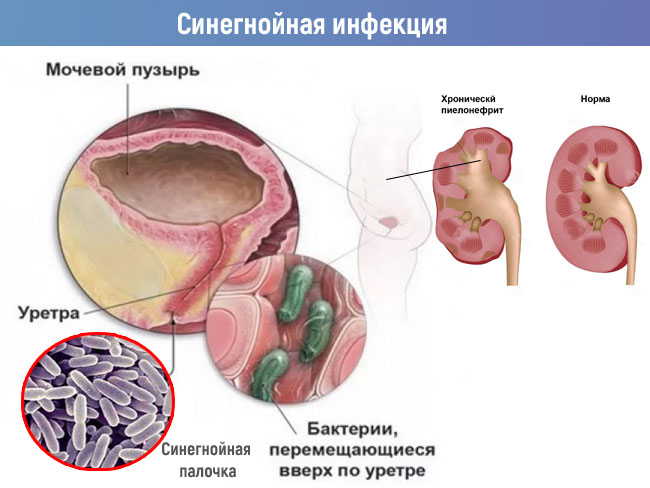 синегнойная инфекция мочевыводящих путей