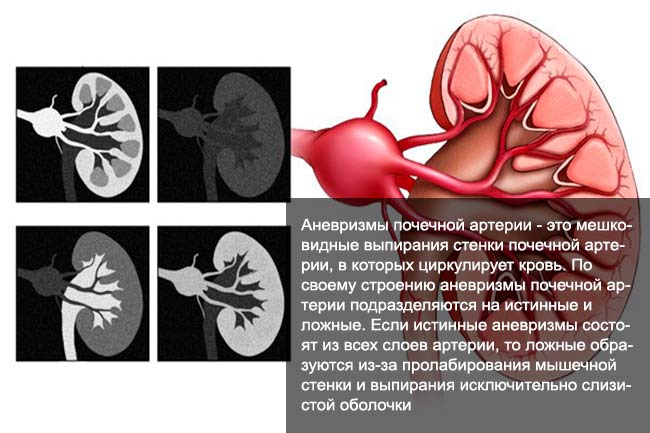 Аневризма почечной артерии