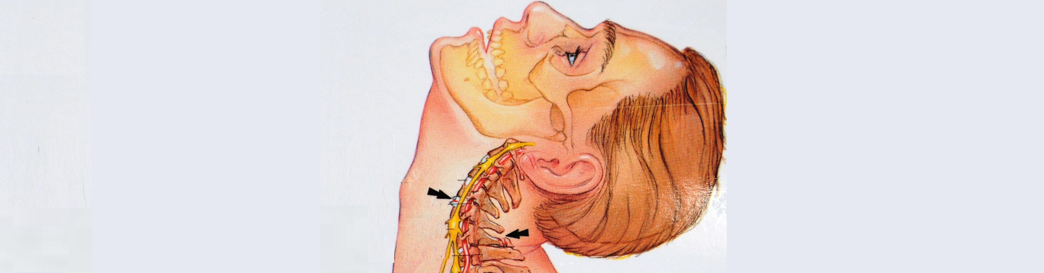 Лечение защемления нерва в грудном отделе позвоночника. Защемление нерва в шейном отделе. Нервы в шейном отделе позвоночника.