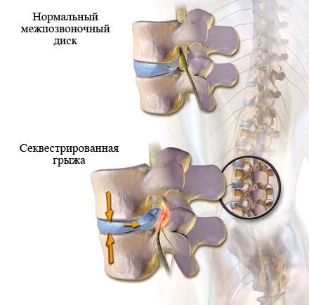 6 методов лечения секвестрированной грыжи спины, нужна ли операция?