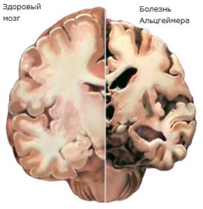 Мозг при болезни