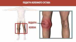 Способы лечения боли в коленах