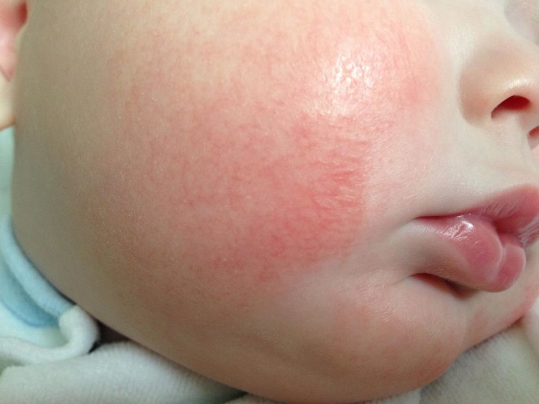 Аллергический дерматит на лице у ребенка