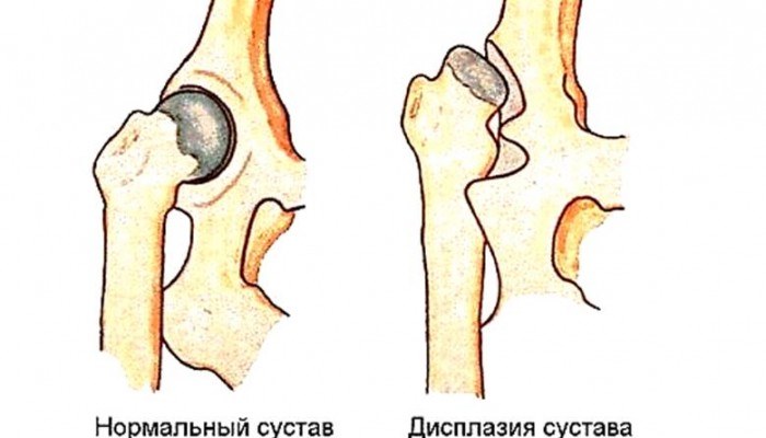 3 этапа нормального развития ядер окостенения тазобедренных суставов