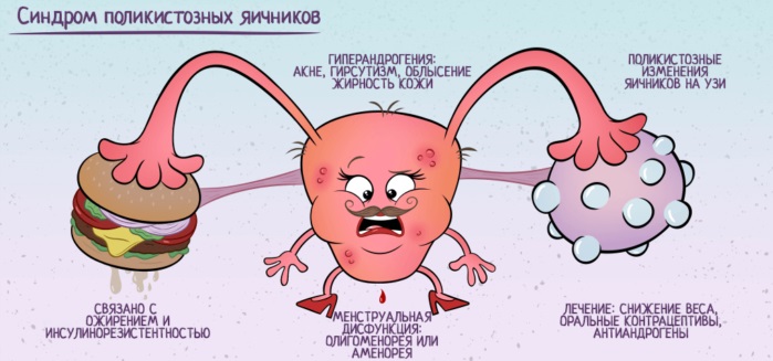 Поликистоз яичников симптомы и лечение фото