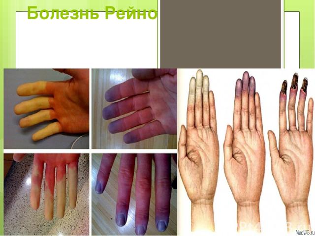 Онемение пальцев рук: причины, лечение, что делать?