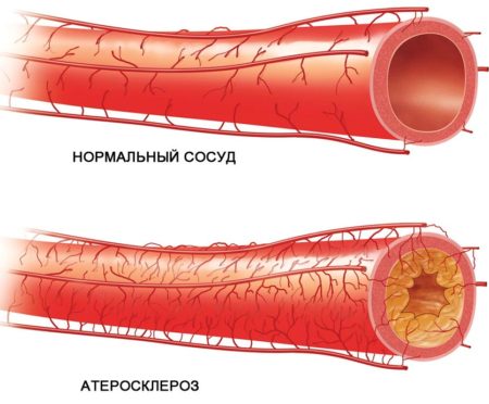 Механизм действия «Аспаркама» при повышенном артериальном давлении, инструкция по применению, противопоказания, показания и взаимодействия