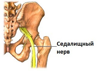 Защемление нерва в пояснице (заклинило спину) если боль отдаёт в ногу