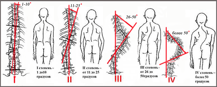 10 причин искривления спины в поясничном отделе (сколиоз)