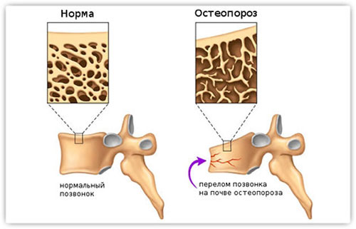 8 симптомов и причины остеопороза позвоночника. Как лечить, не усугубив?