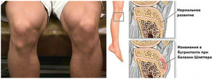 Что такое болезнь Шляттера коленного сустава
