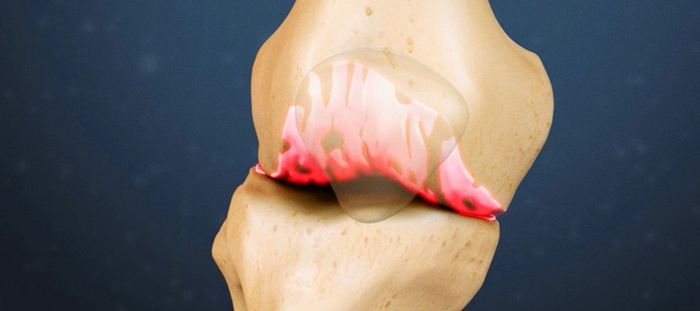 Причины отложения солей в коленных суставах, как лечить?