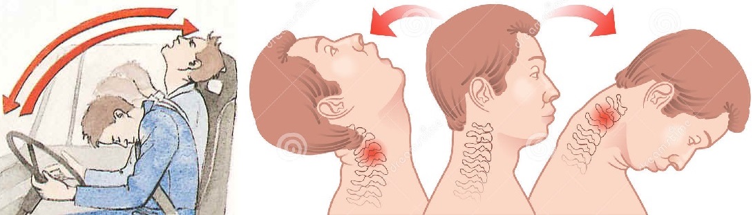 Хлыстовая травма шеи и позвоночника 3 признака и симптомы