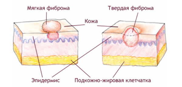 Дерматофиброма