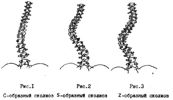 Таблица способов лечения S,Z,C образного сколиоза