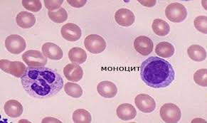 Какие заболевания являются причиной отклонения моноцитов в сторону повышения?