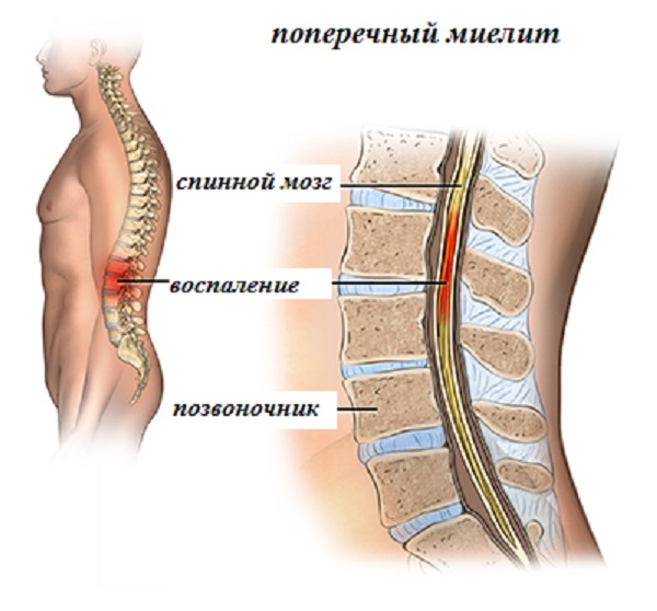 Воспаление спинного мозга или острые миелит, лечение и восстановление подвижности ног