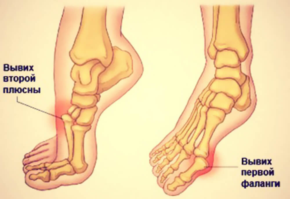 6 видов вывиха стопы стадии травмы и правильное лечение