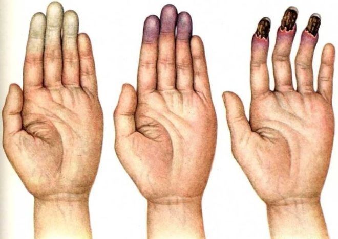 10 причин онемения кончиков пальцев на руках. Проверьте, чем вы можете быть больны