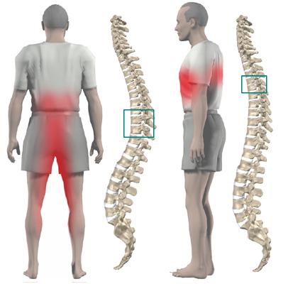 6 методов лечения секвестрированной грыжи спины, нужна ли операция?