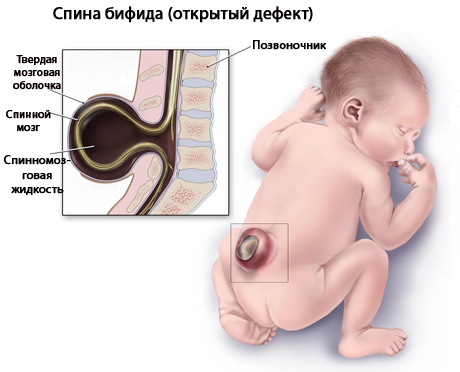 Опасное заболевание спины у каждого 5-го новорождённого, чаще всего по вине родителей! (Спина Бифида)