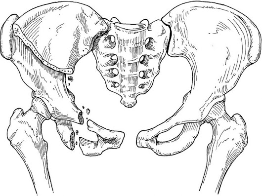 Перелом седалищной кости 5 симптомов, реабилитация и последствия