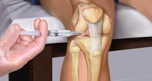 Блокада коленного сустава болезнь или лечение уколами в сустав?