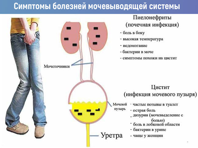 Симптомы болезней мочевыводящей системы