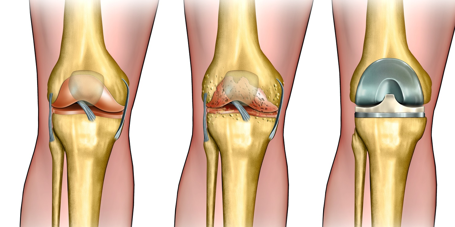 Как избежать коксартроз коленного сустава 9 причин заболевания