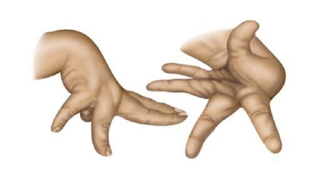 Кривые пальцы