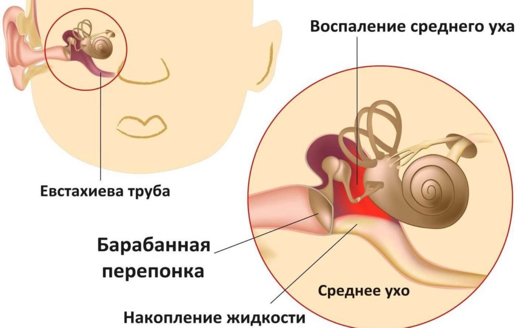 Воспаление среднего уха - отит