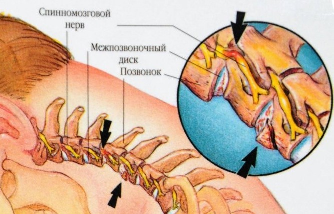 Боль в шее слева 15 возможных заболеваний. Узнайте что у Вас!