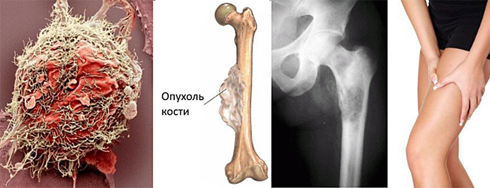6 симптомов остеогенной саркомы бедренной кости. Ранние признаки и прогноз