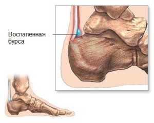 Воспаление голеностопного сустава 6 признаков проявления, как правильно лечить?