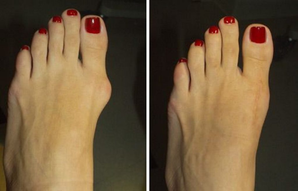 7 возможных причин боли косточки на ноге, около большого пальца