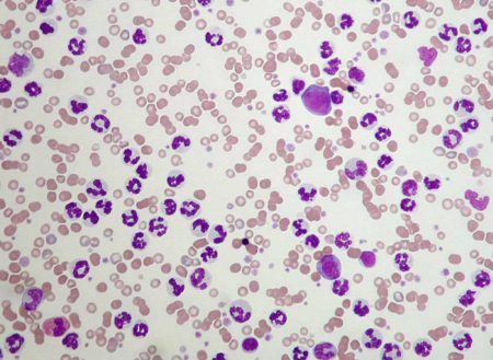 Отклонения от нормы уровня гемоглобина и лейкоцитов при раке, как скорректировать значения