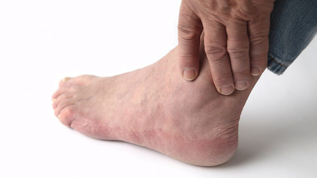 Артрит большого пальца ноги, как лечить косточку на ноге?