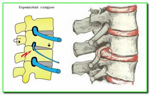 Радикулопатия шейного отдела позвоночника и поражение межпозвоночного диска
