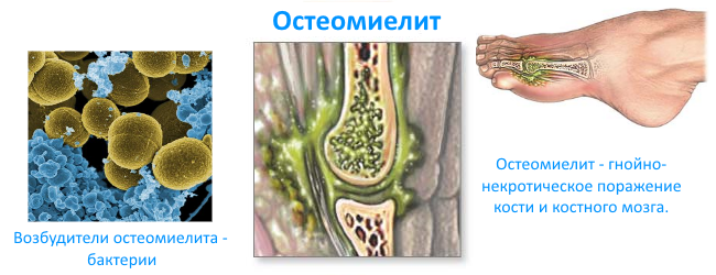 Остеомиелит (воспаление костного мозга) позвоночника 3 симптома и последствия
