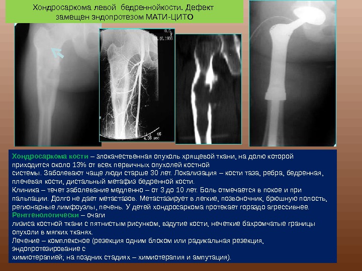 Хондросаркома тазобедренной кости 3 степени, симптомы и лечение