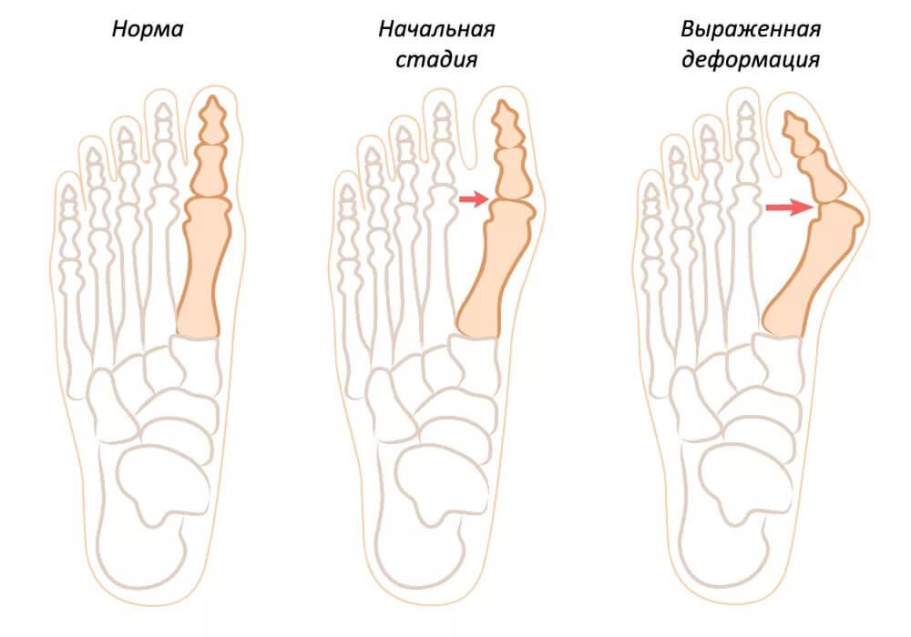 4 стадии деформации косточки на ноге, как лечить?