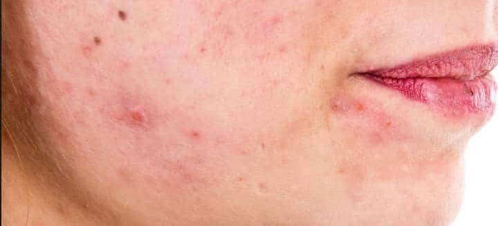 аллергия в виде высыпаний на коже