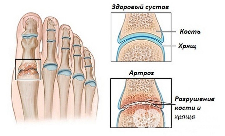 Артроз большого пальца ноги симптомы и лечение