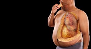 Ожирение и атеросклероз взаимосвязанны