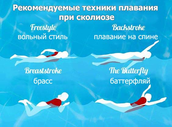 5 упражнений в бассейне, для лечения сколиоза. Как нужно плавать?