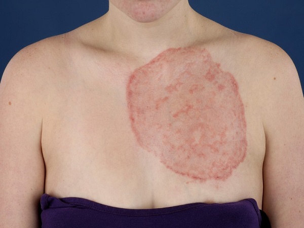 Грибковое заболевание кожи - дерматомикоз