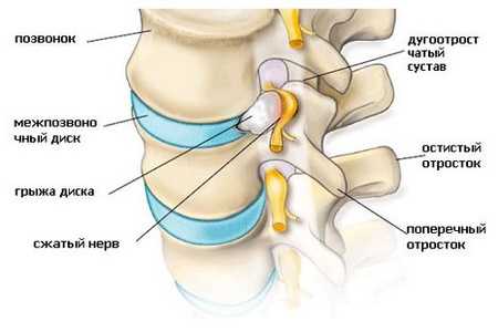 Корешковый остеохондроз или синдром: шейный, грудной, поясничный, крестцовый.