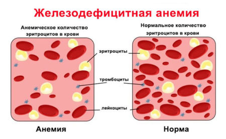Эффективность уколов для поднятия гемоглобина при анемии, виды препаратов, способы применения