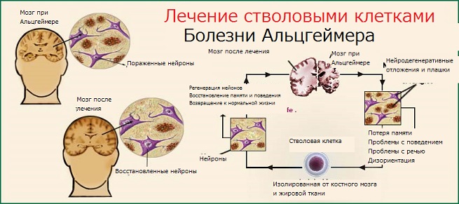 Лечение стволовыми клетками