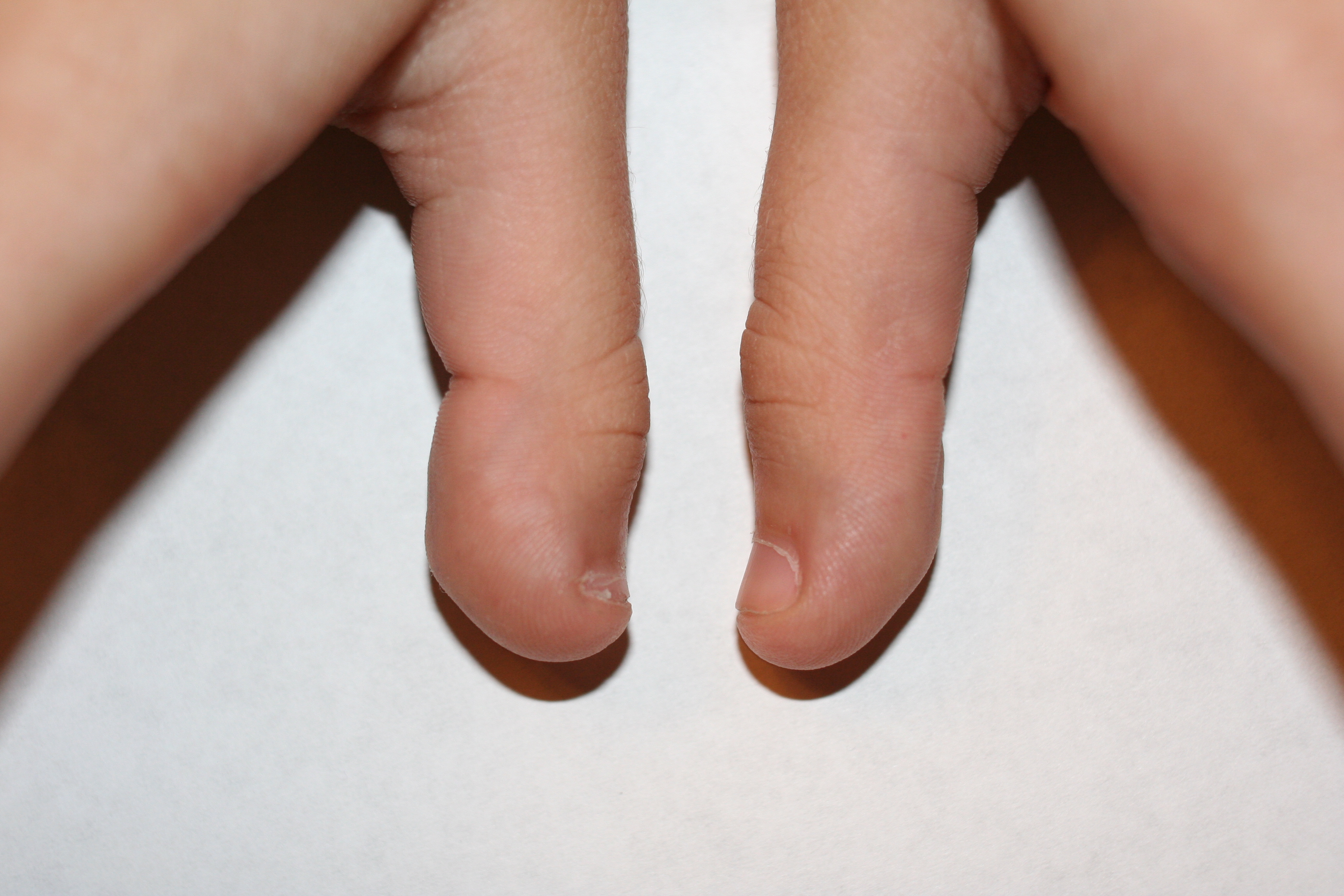 Что такое брахидактилия большого пальца и почему она возникает?